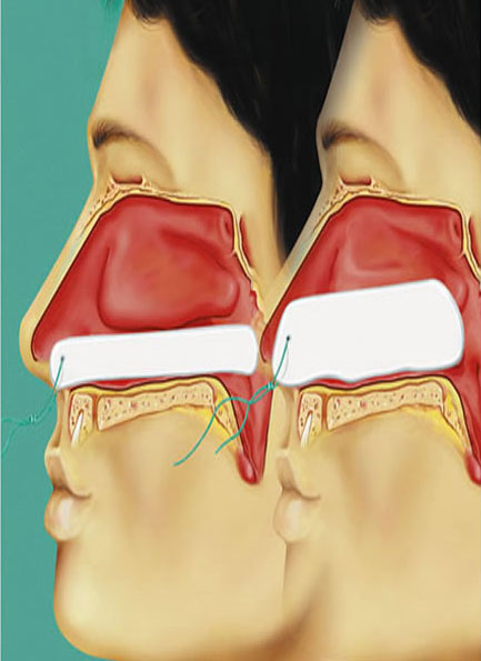 Raucocel Tamponamento nasal recto com fio - 45 mm