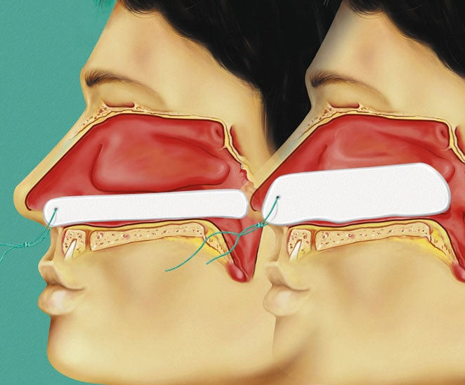 Raucocel Compressa nasal para hemorragias nasais - 55 mm